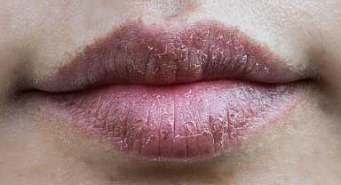 Dudak Nemlendiricileri Çatlakları Artırabilir mi? Dermatologlardan Uyarılar
